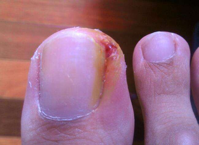 甲沟炎剪指甲好还是不剪好,很多人甲沟炎