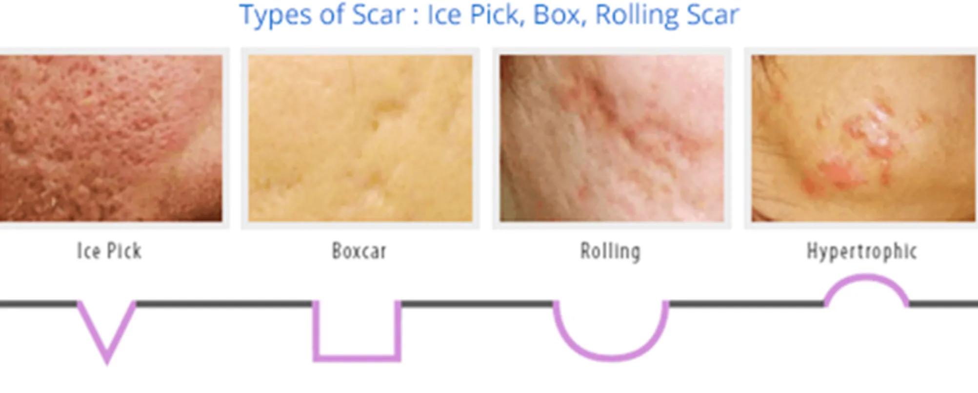 长疱疹的伤疤怎么治,长疮的疤痕怎么消除