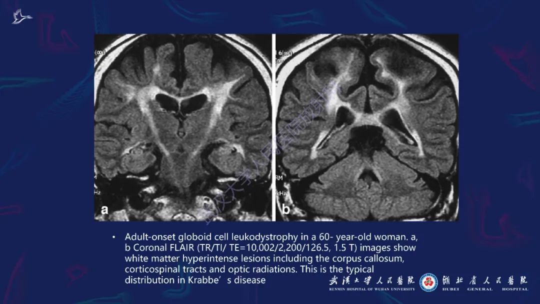 胼胝体肿瘤影像鉴别,胼胝体病变影像诊断