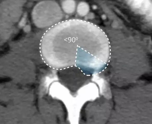 腰椎间盘的膨出和突出有什么区别,腰椎间盘膨出和突出有什么区别
