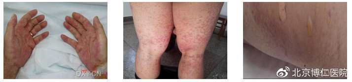 移植后排异反应都有哪些症状,移植后的排异有什么症状