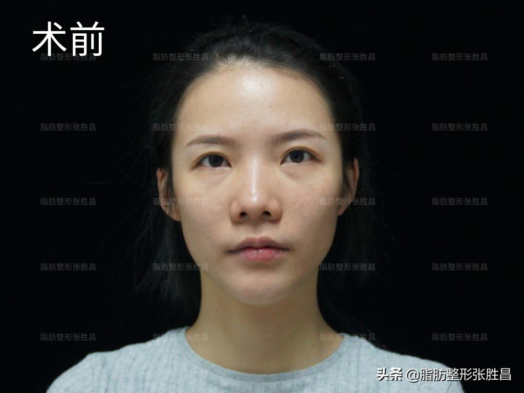 为什么脂肪填充要全麻,为什么脂肪填充算是整容