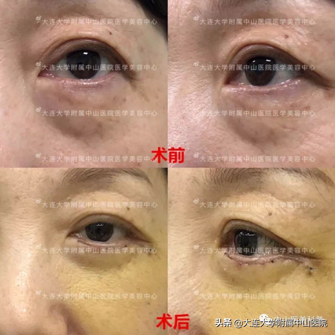 你有没有被自己的眼袋困扰过,关于眼袋的科普在这里