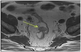 直肠神经内分泌肿瘤分级和治疗,直肠神经内分泌肿瘤到底是不是癌