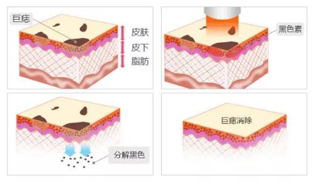激光祛痣留疤了的图片,激光祛痣后会不会留疤