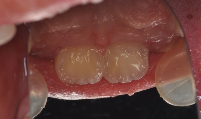 牙拔掉后扔掉还是留着,牙折断还能接回去吗