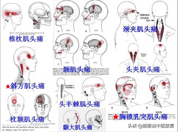 激痛点挂图,激痛点疗法笔记