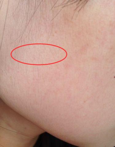 用烟酰胺脸毛会越来越长吗,烟酰胺停止使用脸上的黑毛会好吗