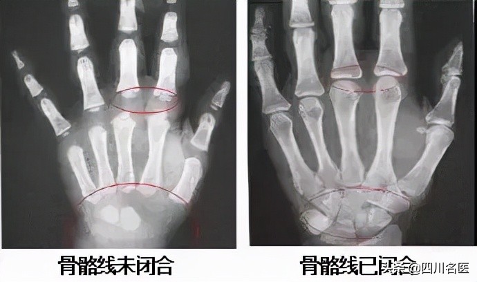 华西附二矮小症生长激素,花48万打增高针