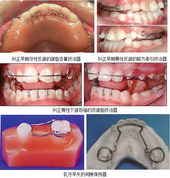 隐形牙套矫正和钢牙矫正哪个好,隐形牙齿矫正牙套种类