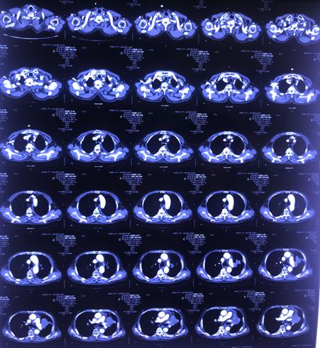安罗替尼适合何种肺癌,柳暗花明好人一生平安