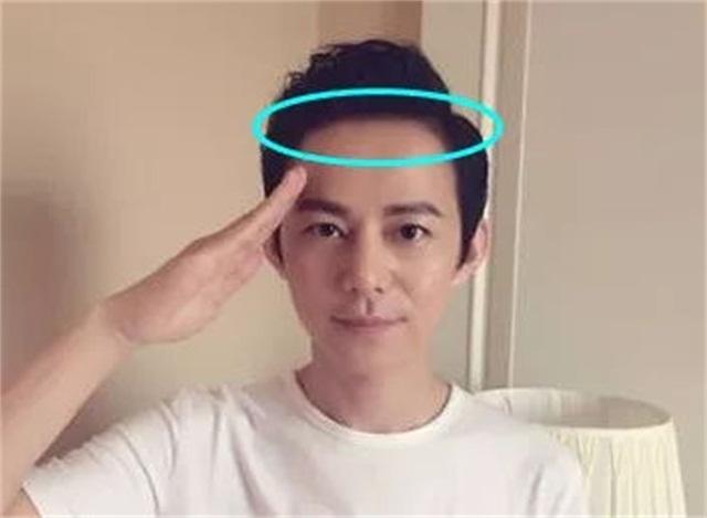 一招教你解决发际线后移,发际线秃了怎么拯救真实案例