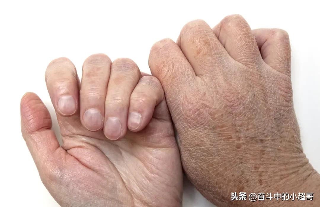 春夏之交肌肤干燥起皮，不一定是花粉的错