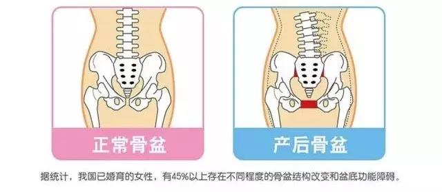 生育损害,生育后做哪些产后修复