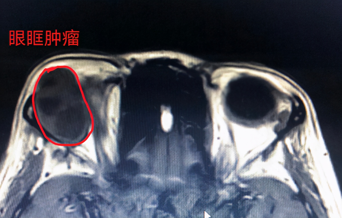 双眼眼球不对称是怎么回事,眼瞳不对称怎么矫正