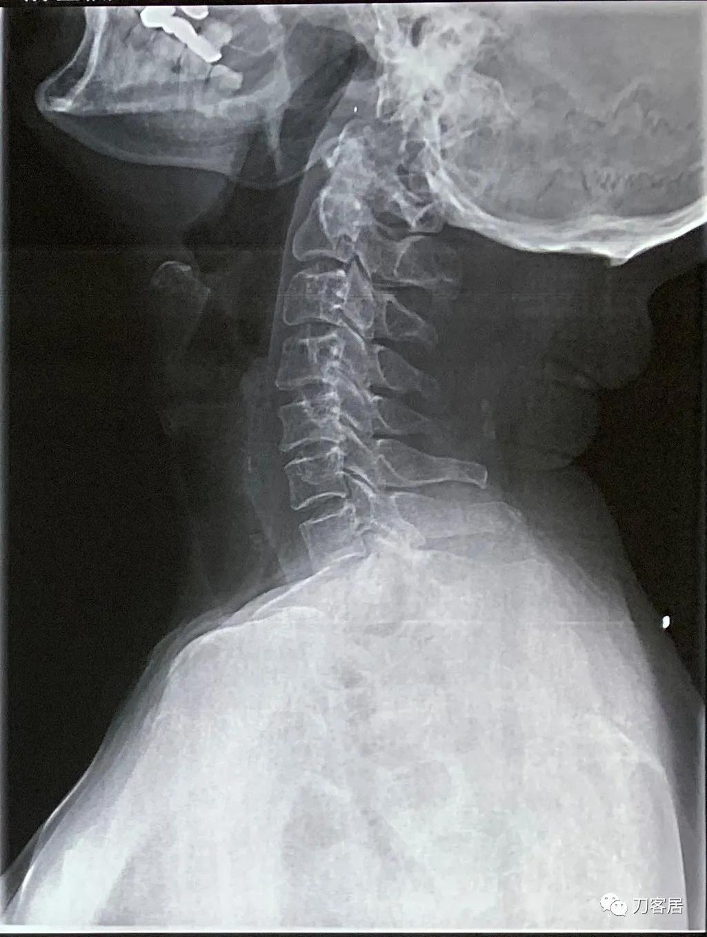 病例左侧躯体麻木,右侧肢体麻木典型病例