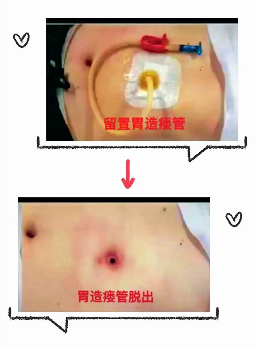胃造瘘术后的护理方法图片,胃造瘘日常护理视频