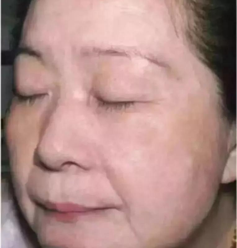 改善暗沉闭口粉刺敏感肌的水乳,如何拯救烂脸痘痘肌