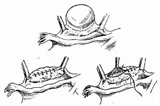 卵巢囊肿手术是把囊肿刺破吗,卵巢囊肿超过5cm需要什么治疗手段
