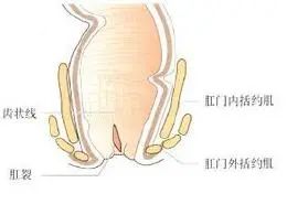 怎么缓解肛裂疼痛睡觉都睡不着,肛裂难受