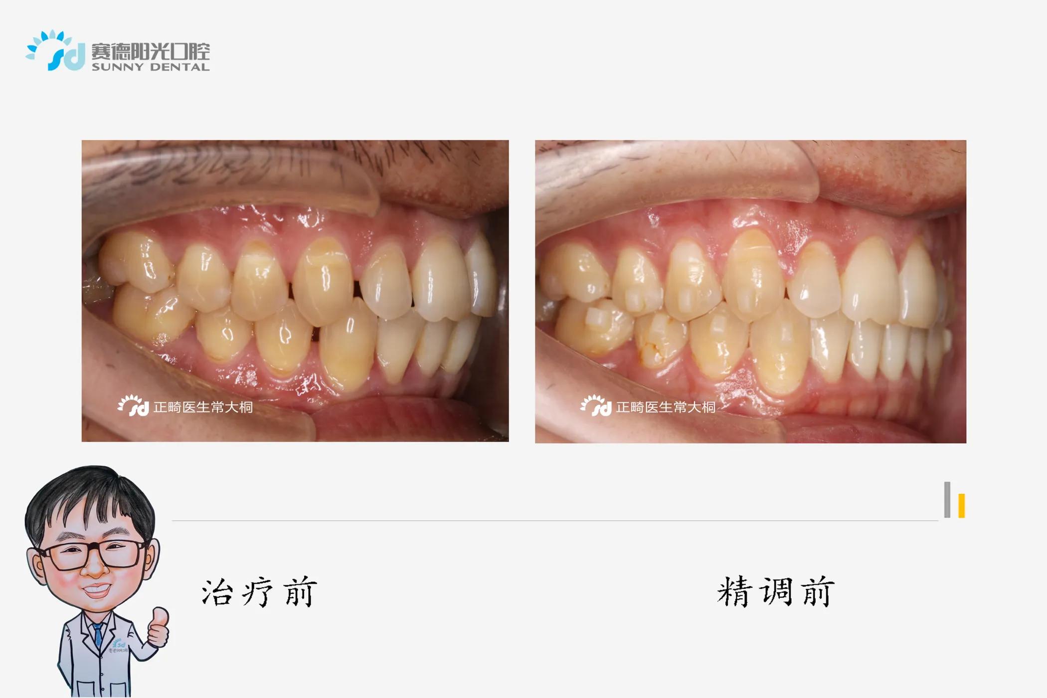 隐适美正畸牙拔掉不美观怎么办,隐适美黑三角什么时候会出现