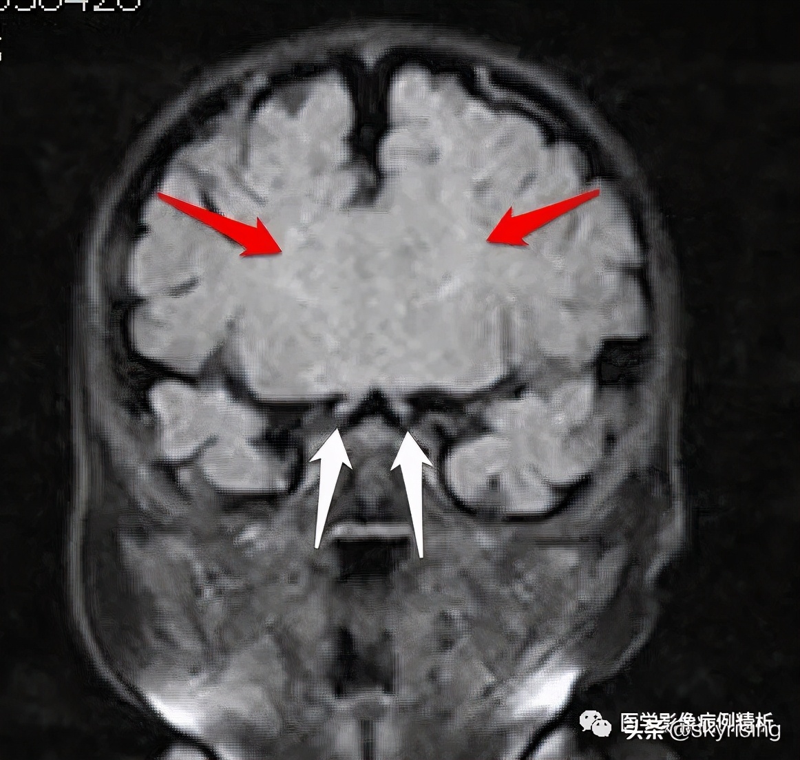 半叶全前脑畸形,无叶型前脑无裂畸形超声表现