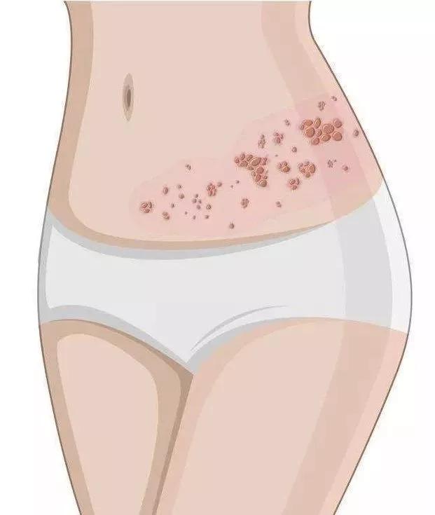 头面部带状疱疹针灸治疗,头部带状疱疹中药治疗要多久