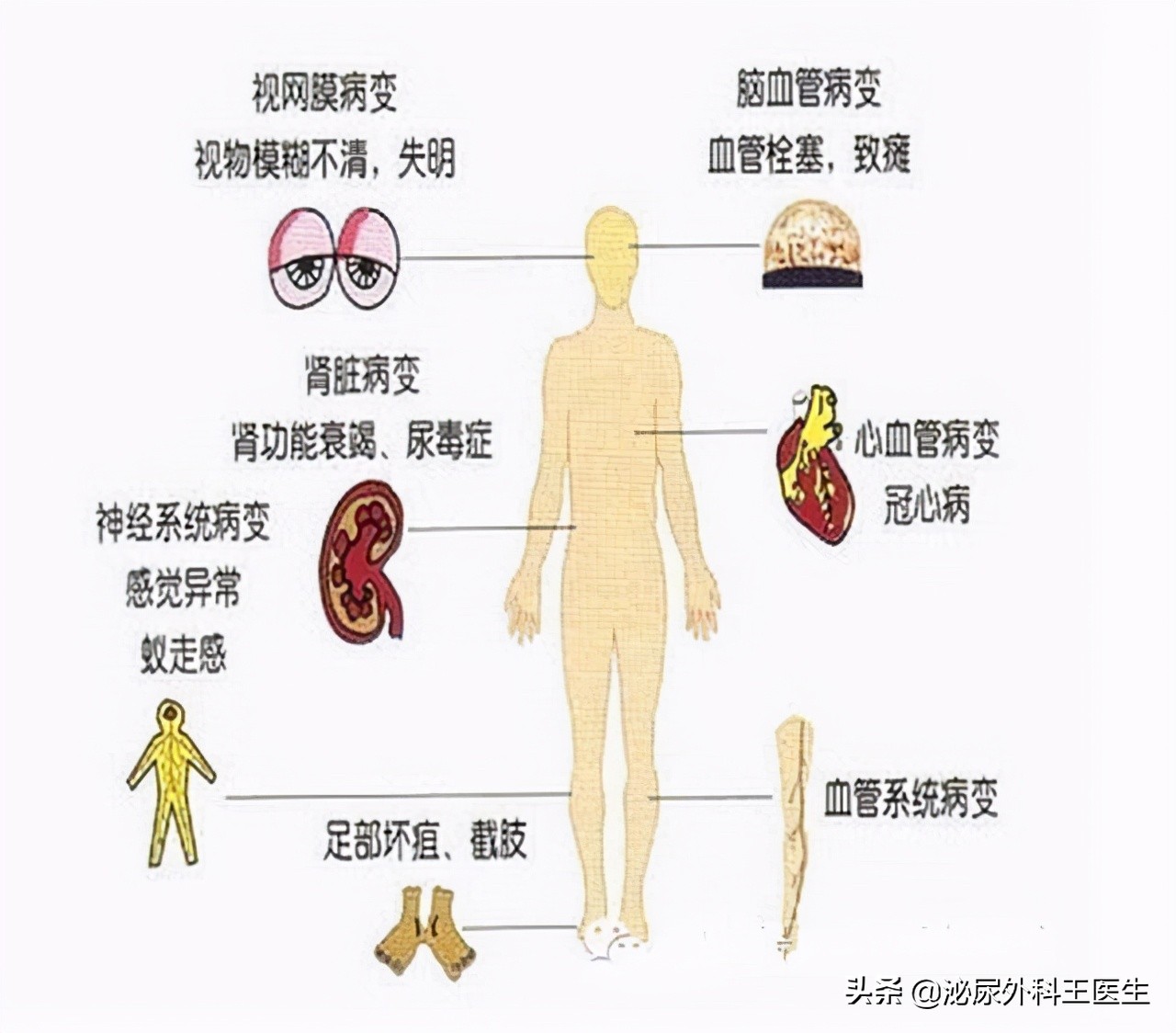 小腿瘙痒是不是糖尿病的并发症,糖尿病胳膊腿瘙痒是并发症严重了