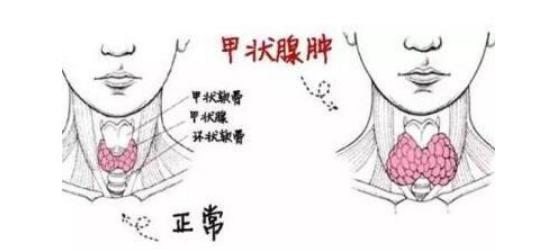 老人甲状腺肿大的最佳治疗方法,八旬医生抢救老人