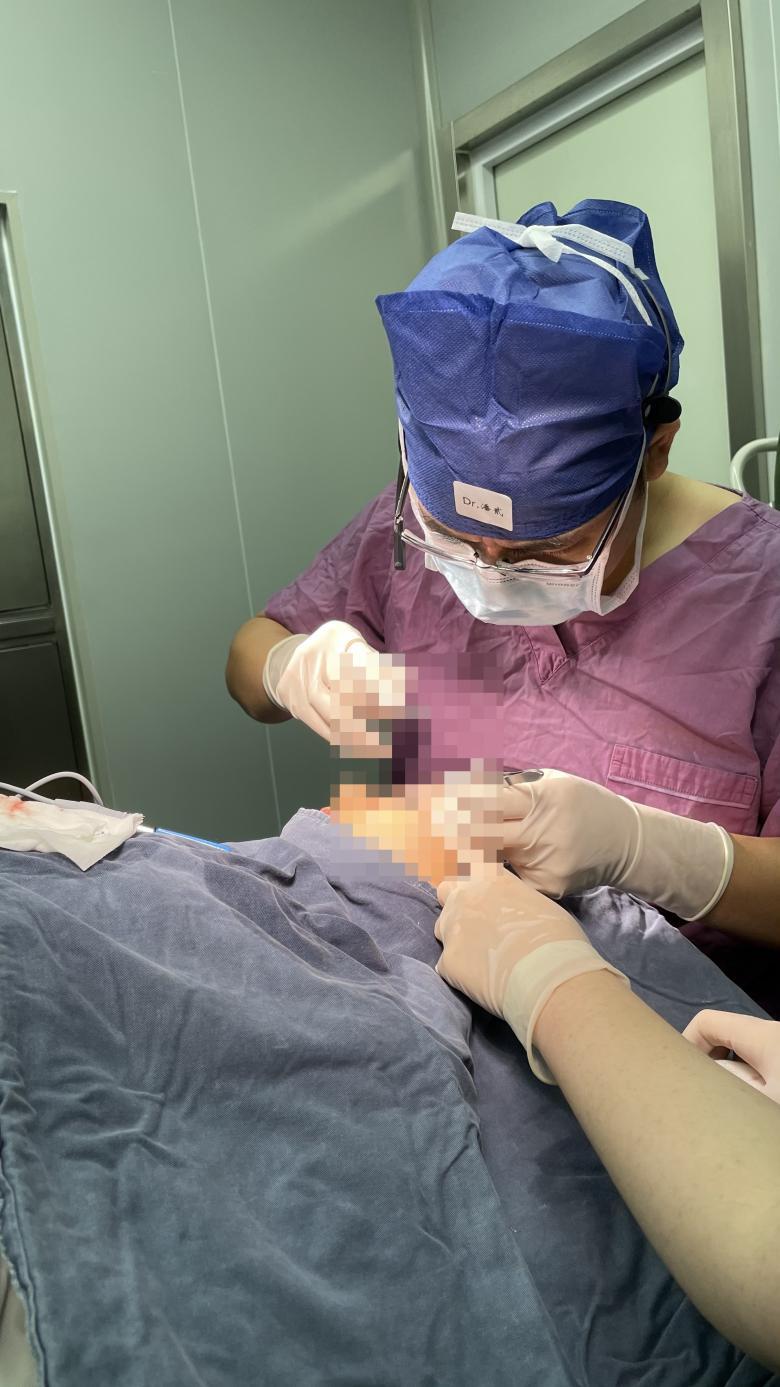 潘二博士双眼皮修复失败案例,潘二医生双眼皮