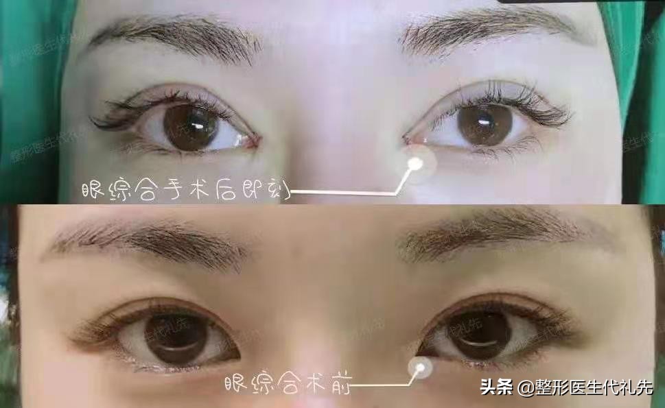 为什么刚做完双眼皮这么难看,为什么刚刚做的双眼皮不好看很假