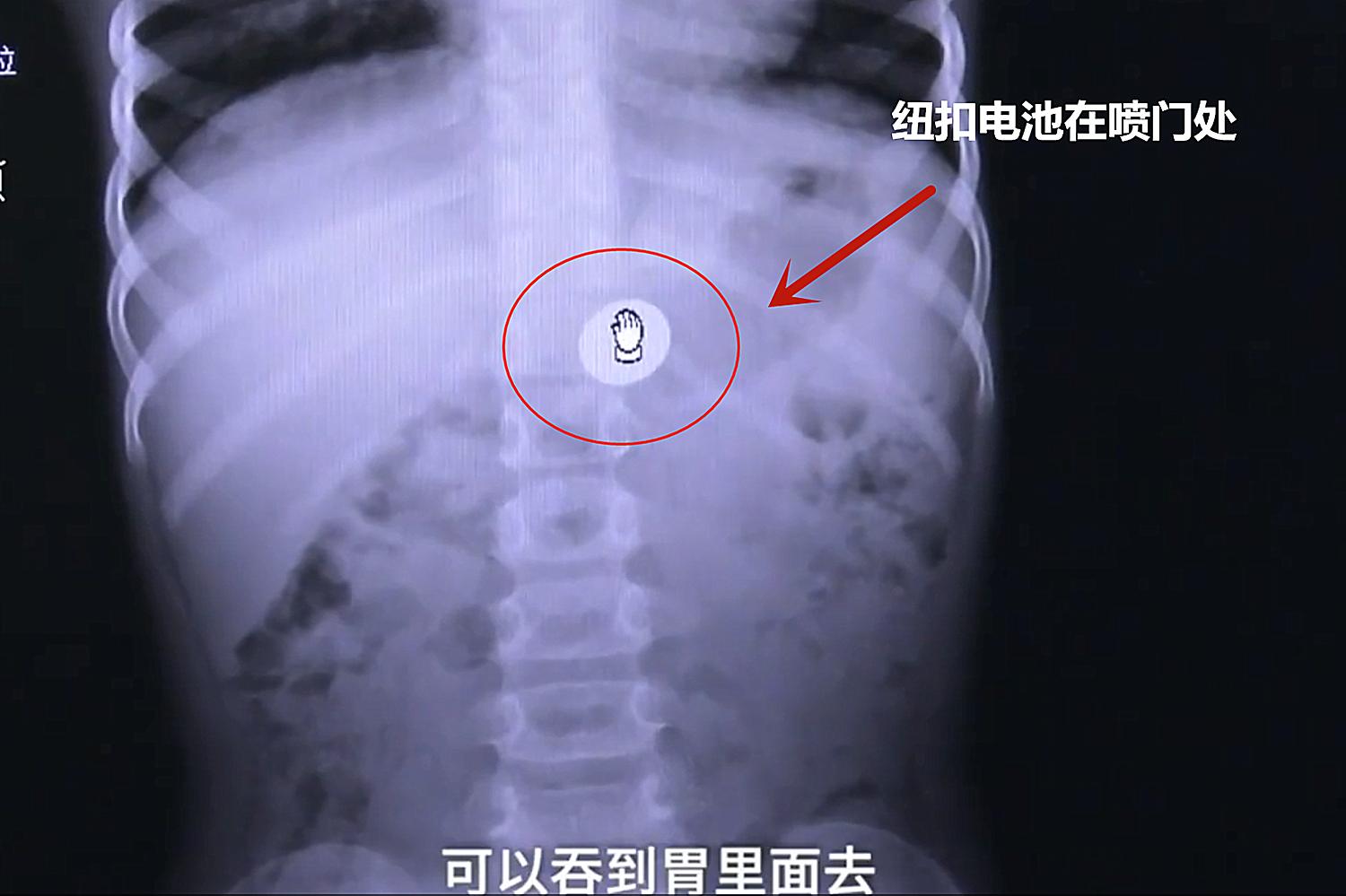 4岁女童误吞一角硬币怎么处理,4岁女童误吞5角硬币