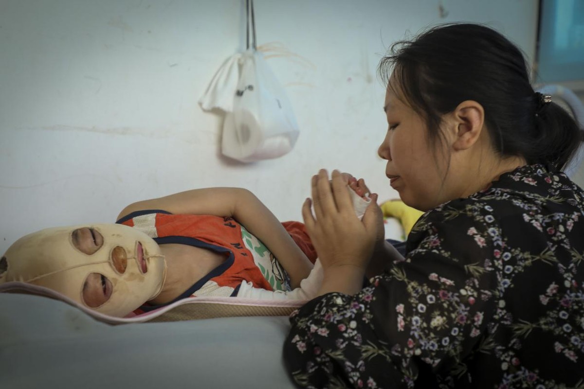 孩子被开水烫伤母亲却只心疼杯子,小孩掉进开水盆80%烫伤