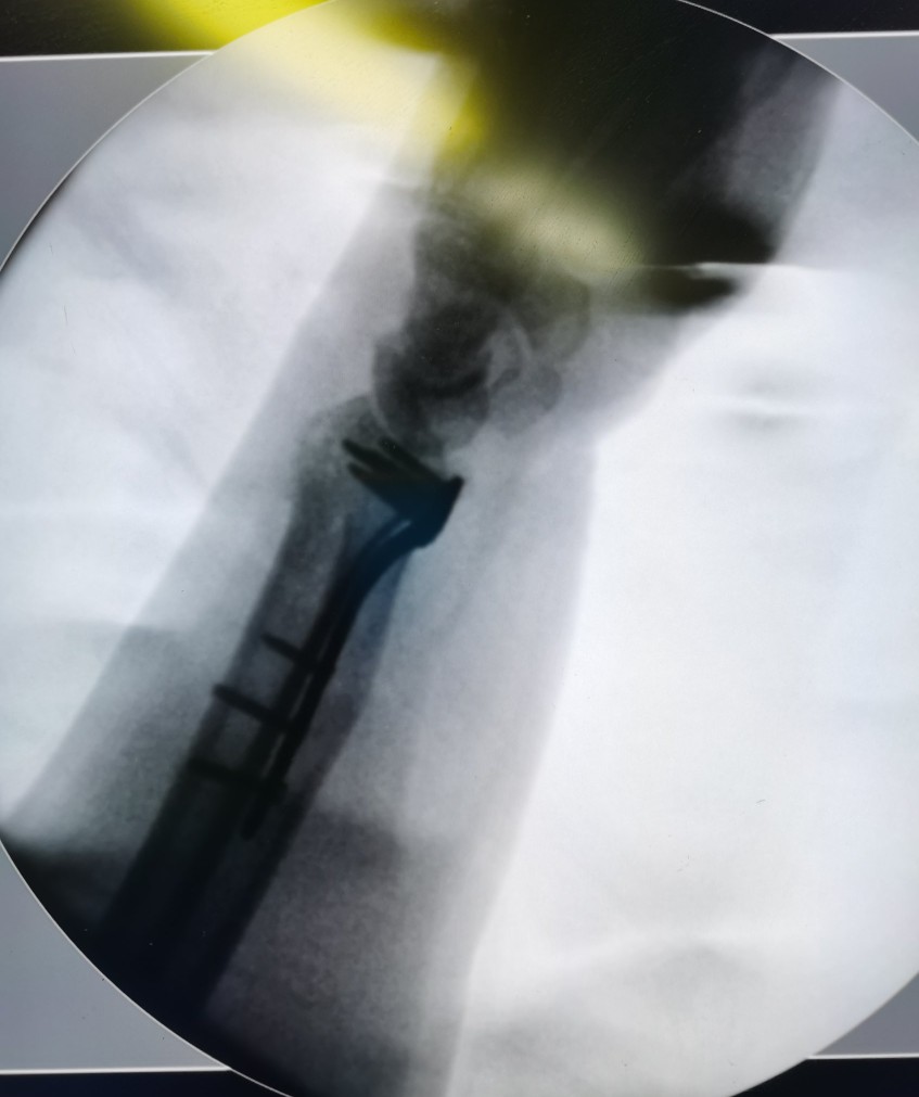 腕关节骨折了怎么办？-桡骨远端骨折篇