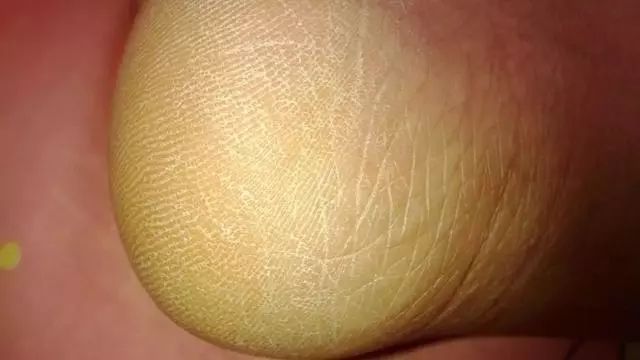 夏天了手脚干裂还有老茧,手脚干裂脱皮老茧用什么药膏