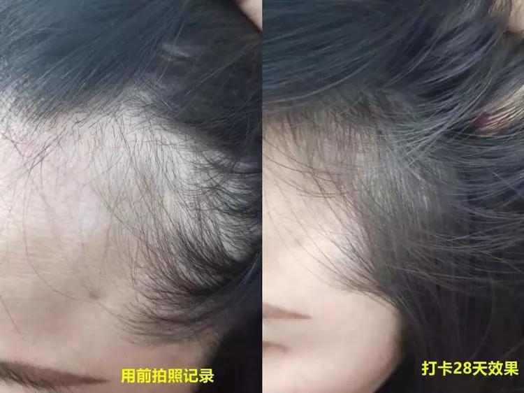 头发毛躁头屑多头皮痒怎么保养,头皮痒头屑多怎么根除