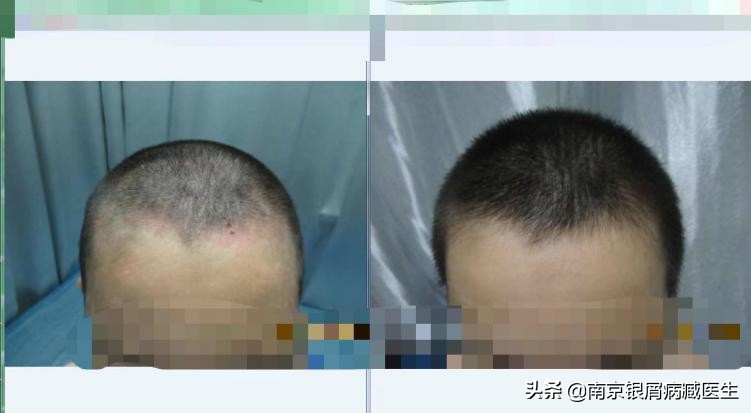 用洗洁精洗头会得银屑病,洗洁精洗头男孩