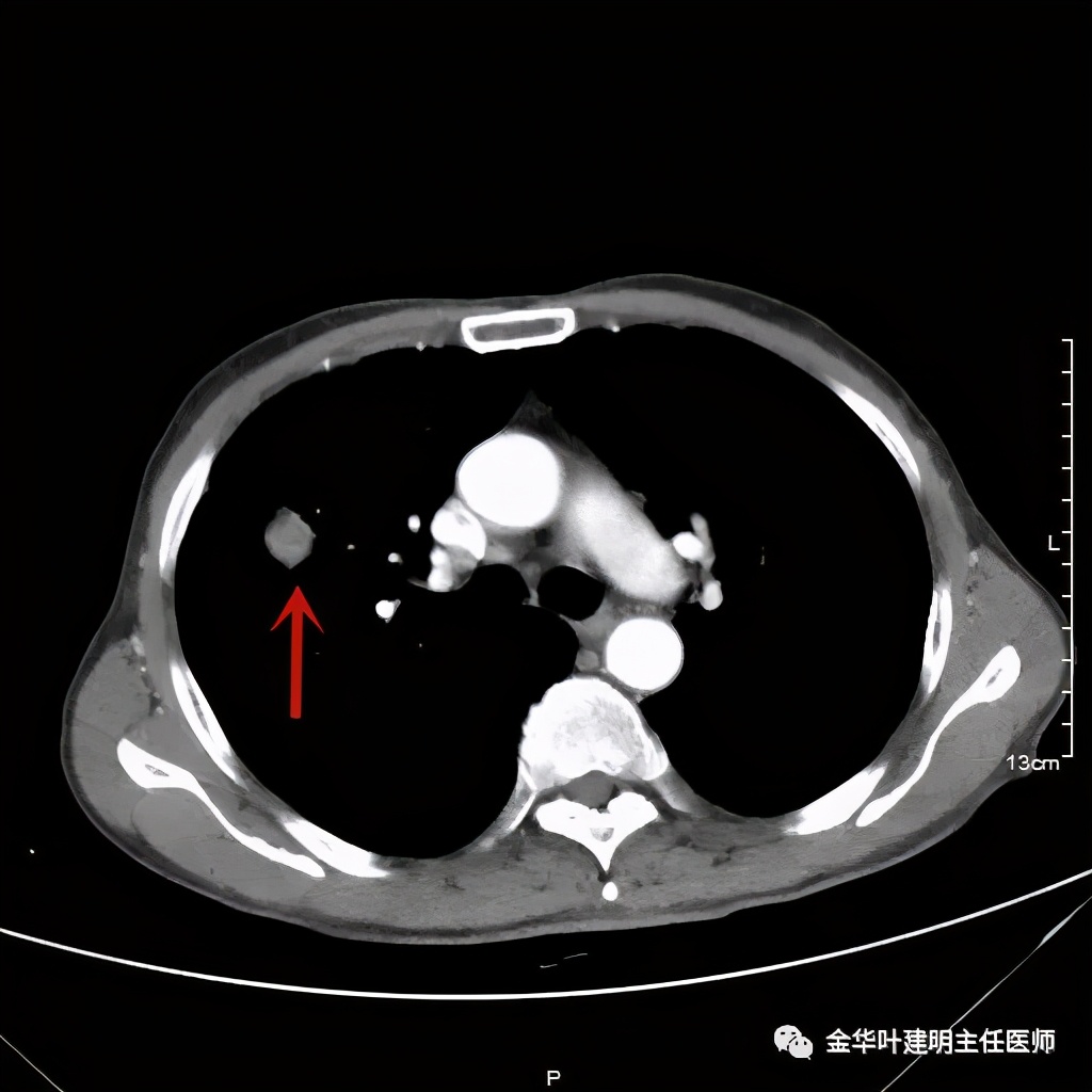 得了肺癌做肺部穿刺有影响吗,肺部穿刺可以确诊肺癌吗
