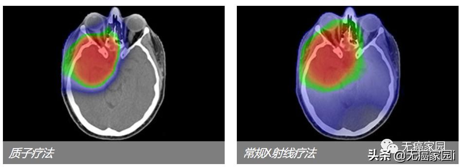 大细胞肺癌脑转移寿命一览表,肺癌转脑生存期