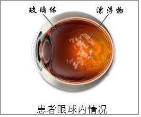 有飞蚊症眼睛睁开一瞬间有黑点,飞蚊症是黑色的圈圈吗