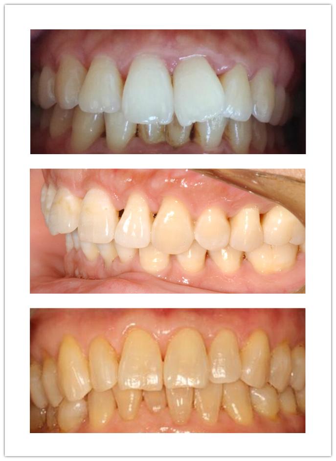 牙齿美白选什么洗牙方式,洗牙美白一般去哪里