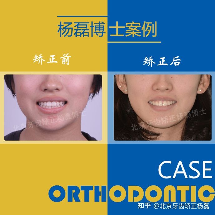 整牙半隐形牙套,缺牙可以用隐形牙套矫正的全过程