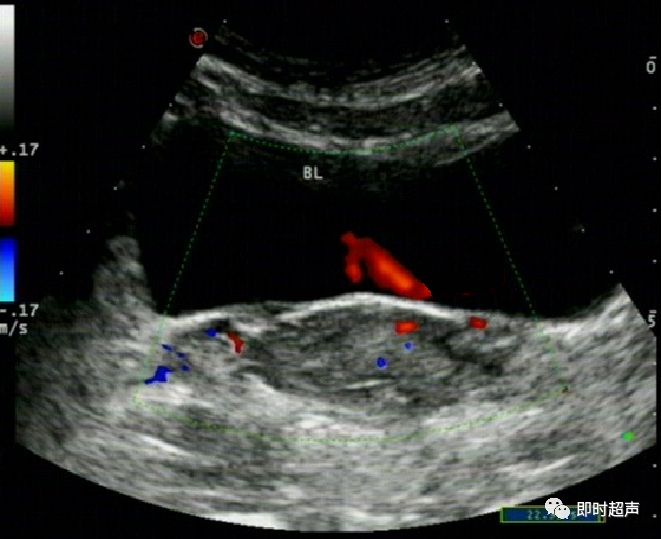膀胱超声图解大全,膀胱超声解剖及常见病变超声表现
