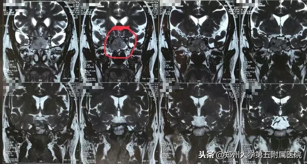 垂体瘤经鼻内窥镜手术,垂体瘤经鼻腔手术会有意外吗