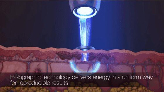 超皮秒激光祛斑真的有效果吗,超皮秒祛斑效果