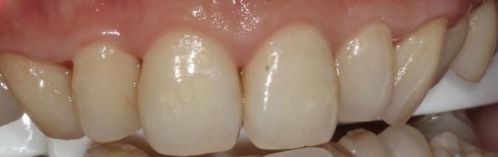 如何让牙齿变白最简单的方法,想要牙齿变白来试试这三种方法