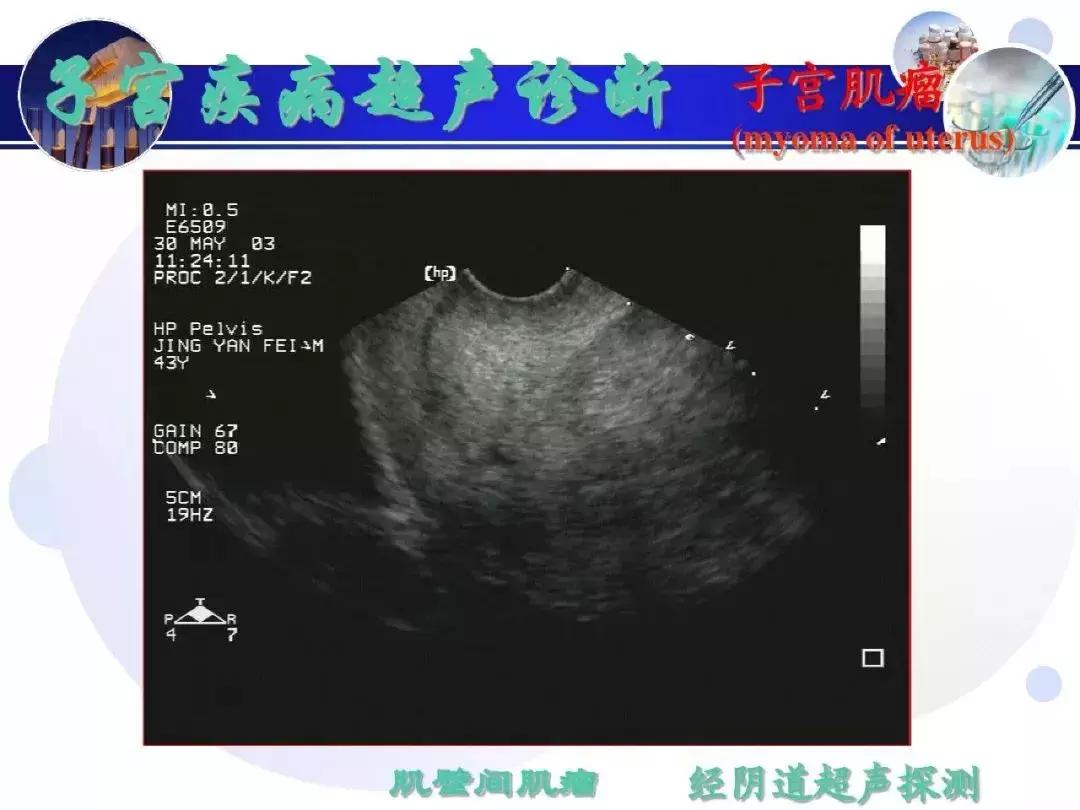 纯干货！子宫及附件解剖和超声诊断