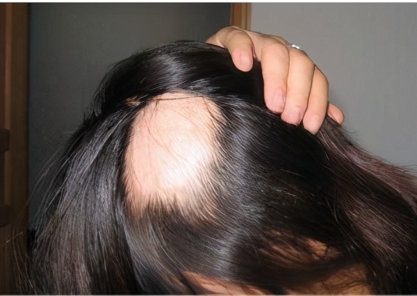 白癜风脱发脱得厉害怎么办,白癜风会导致头发脱落吗