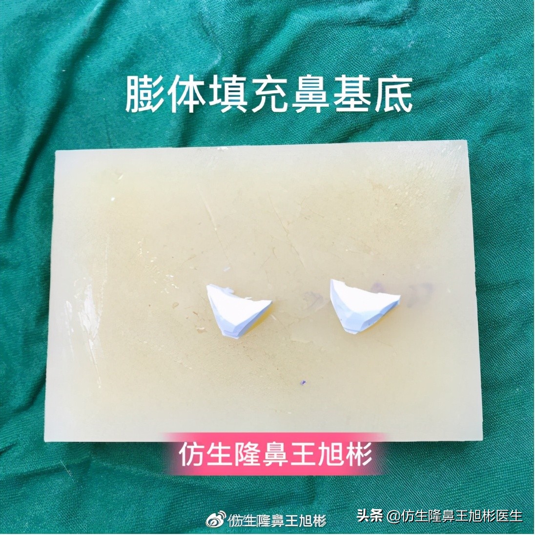 隆鼻鼻型科普,鼻基底凹陷隆鼻可以改善吗