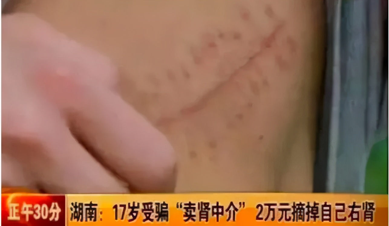 用肾换苹果的高中生,当年用肾换苹果手机的学生现状